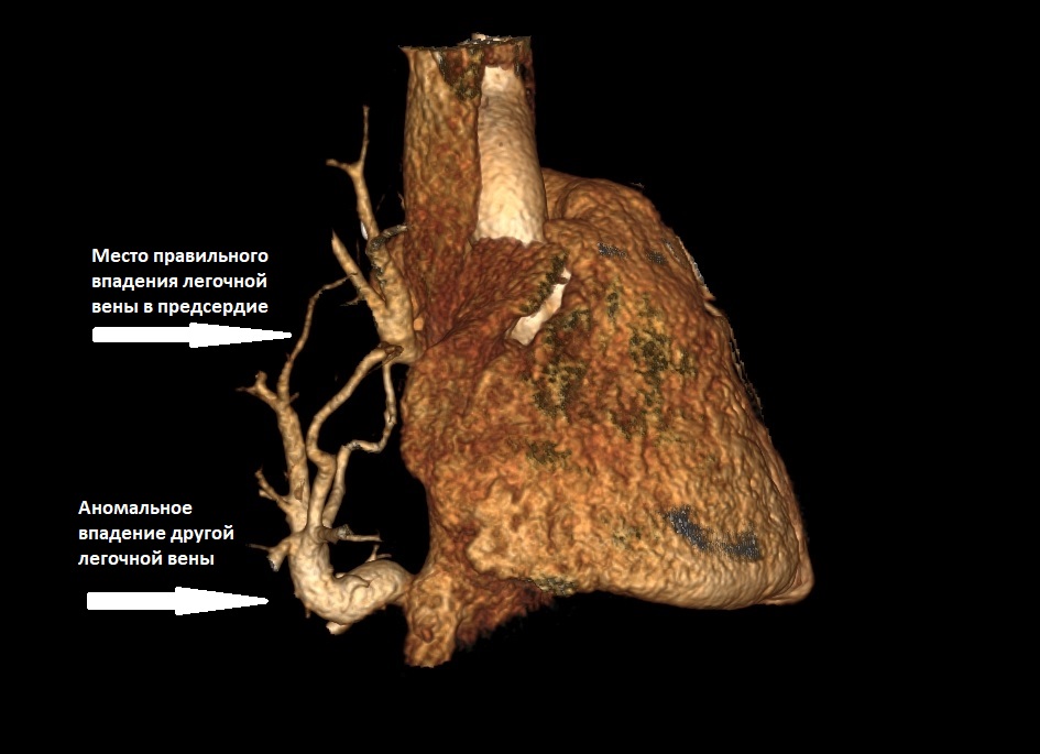 Синдром турецкой сабли. До операции.jpg Синдром турецкой сабли. До операции.jpg